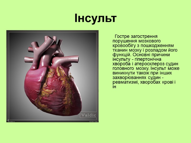 Інсульт         Гостре загострення порушення мозкового кровообігу